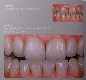 helle Frontzahnschalen (Veneers) statt dunkler kurzer Zähne